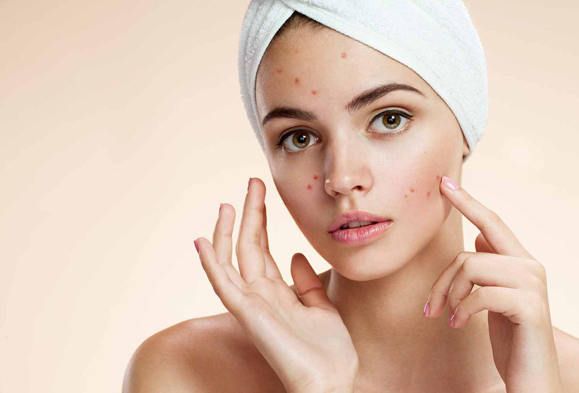 Acne & Pimples: What's Happening Beneath our Skin?